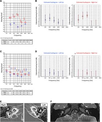 Case report: Cochlear implantation was effective for progressive bilateral severe hearing loss associated with Kawasaki disease